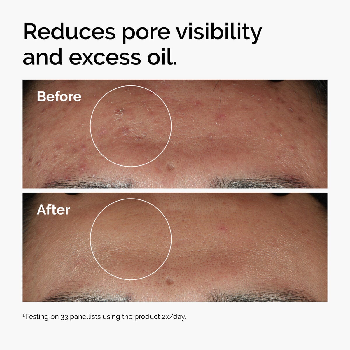 niacinamide-10-zinc-1-y1 ord-niacinamide-zinc-blemish-serum-before-after-pores.jpg