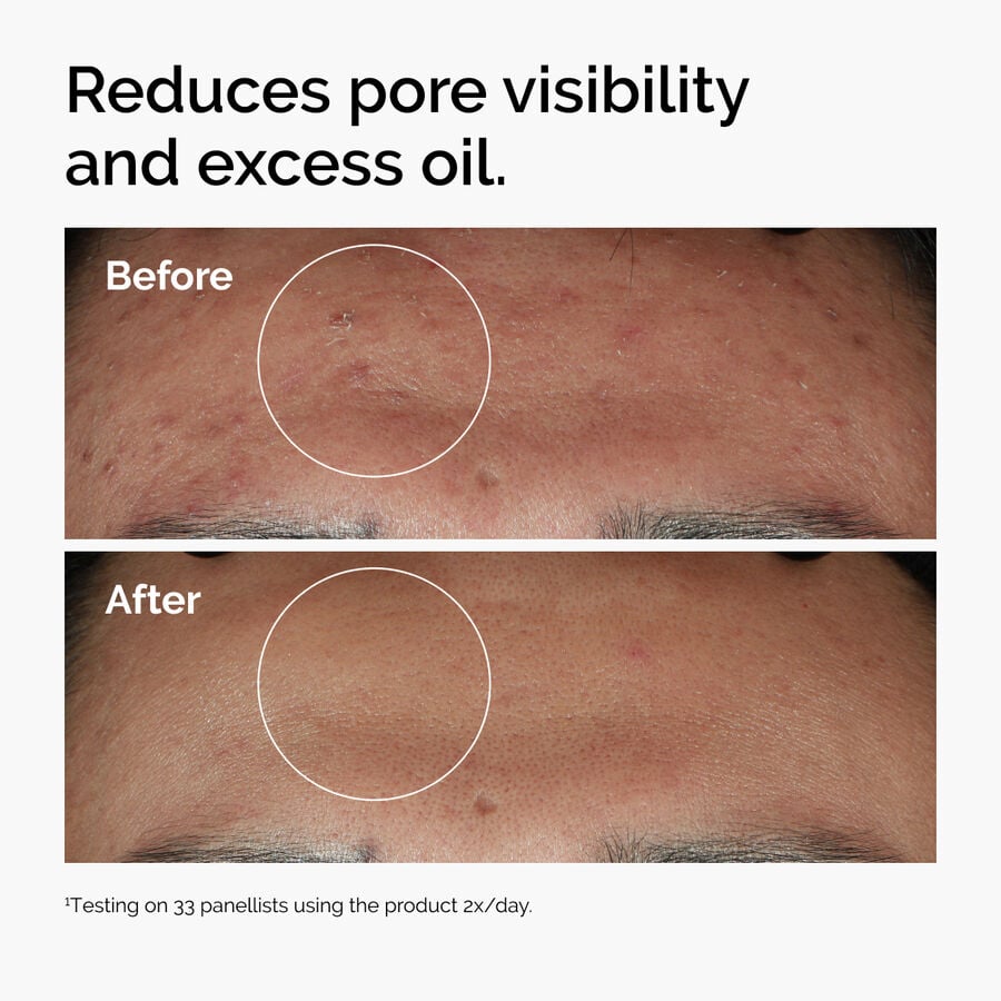 niacinamide-10-zinc-1-y1 ord-niacinamide-zinc-blemish-serum-before-after-pores.jpg