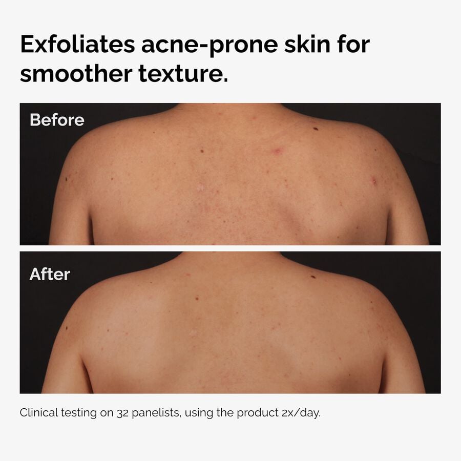 salicylic-acid-0-5-body-serum-k2 ord-salicylic-acid-body-serum-before-after-graphic-NA.jpg