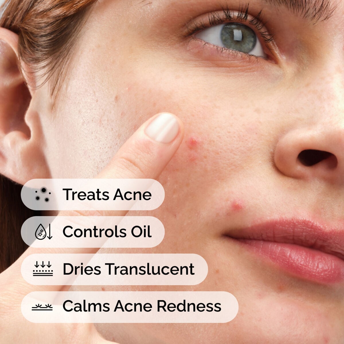 sulfur-10-powder-to-cream-concentrate-u6 ord-sulfur-10pct-powder-to-cream-concentrate-model-application-with-benefits-acne.jpg