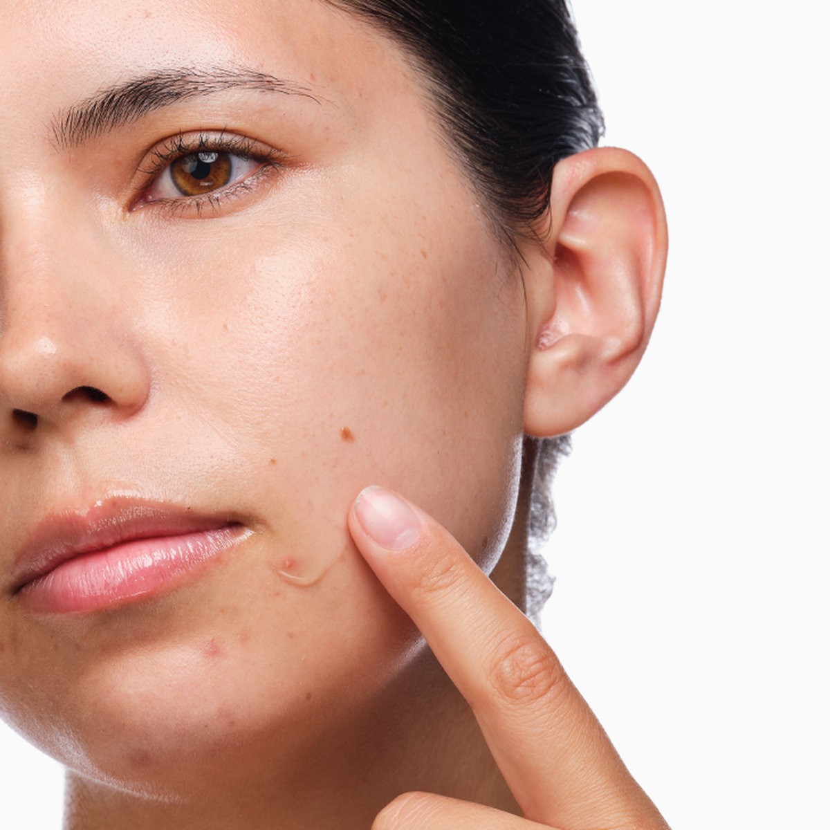 the-acne-set-s7 rdn-the-acne-set-application.png